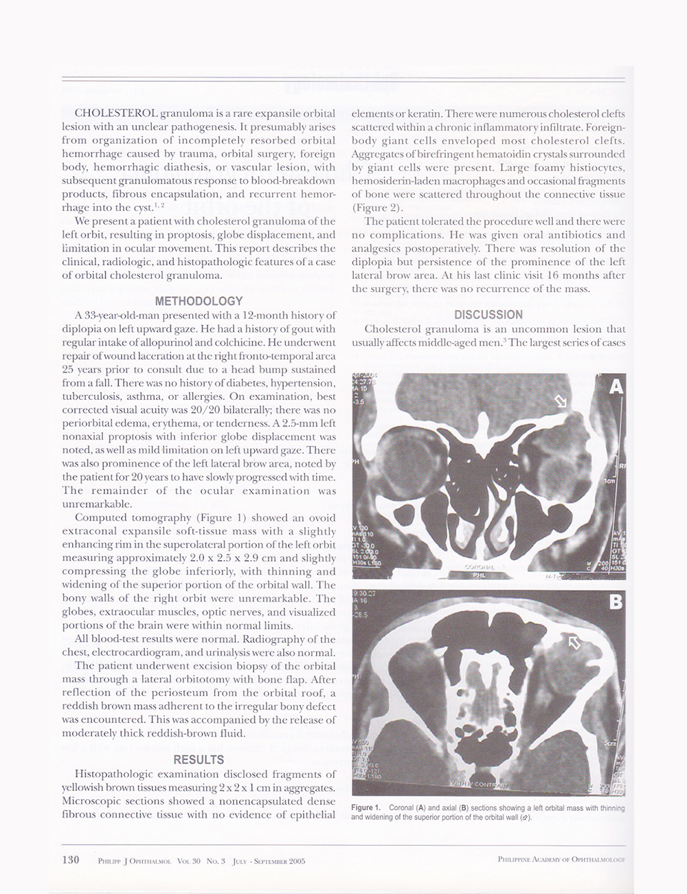 cholesterolgranuloma-p2